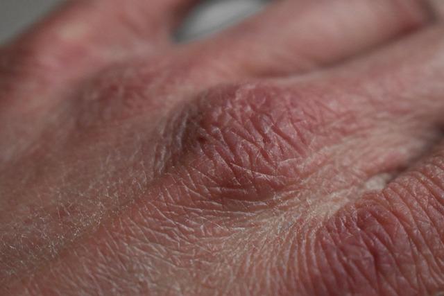 Understanding the Unique Needs of Dry Skin
