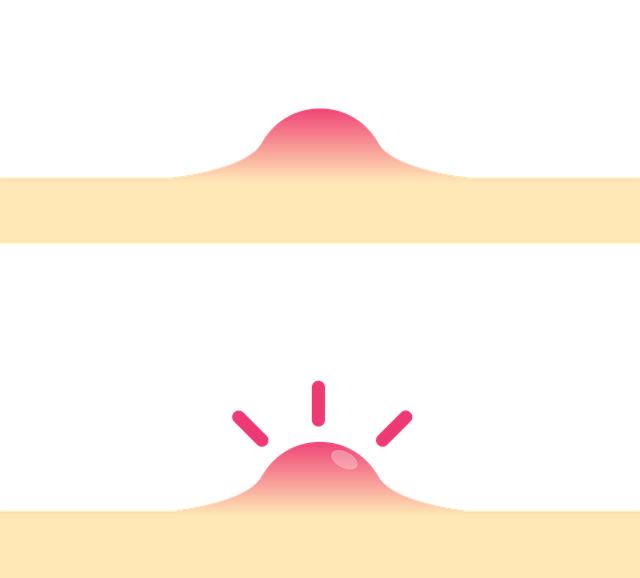 Understanding Sensitive Skin and Acne Challenges